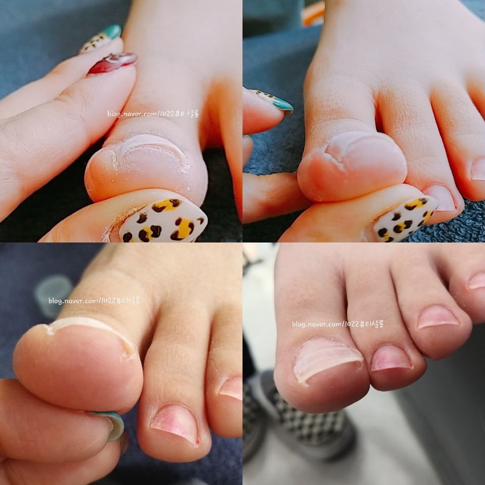 안스네일