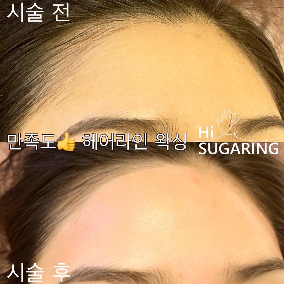 하이슈가링 왁싱