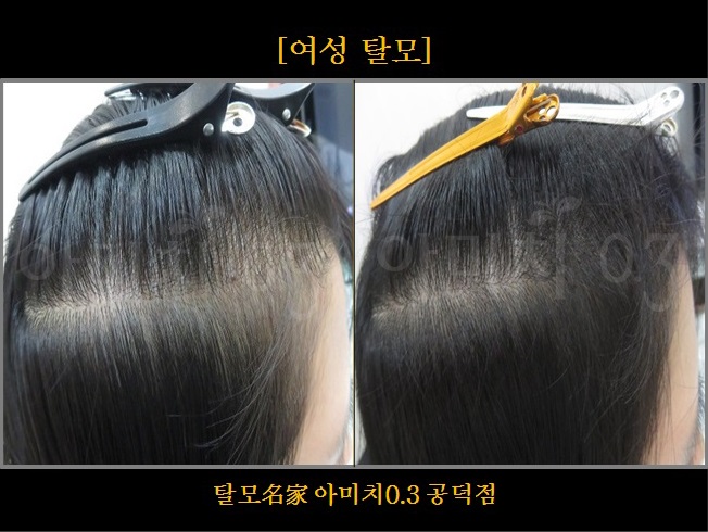 탈모 아미치 0.3 공덕점 대표 이미지