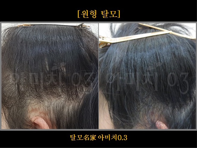 탈모 아미치 0.3 공덕점 대표 이미지