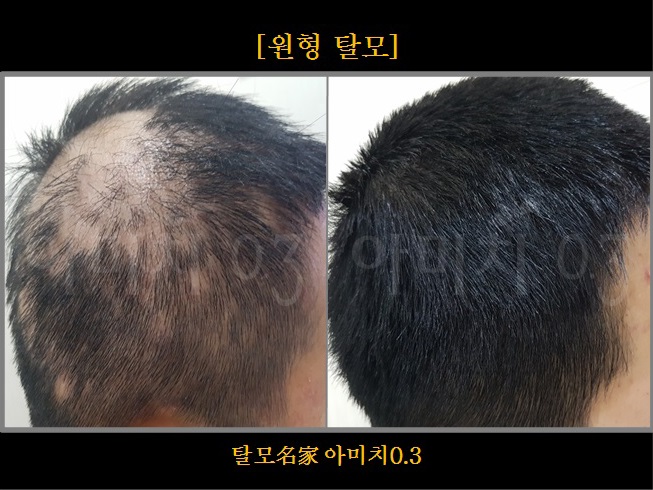 탈모 아미치 0.3 공덕점 대표 이미지
