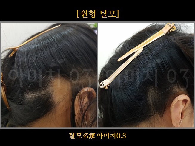 탈모 아미치 0.3 공덕점 대표 이미지
