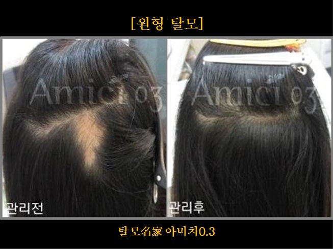 탈모 아미치 0.3 공덕점 대표 이미지