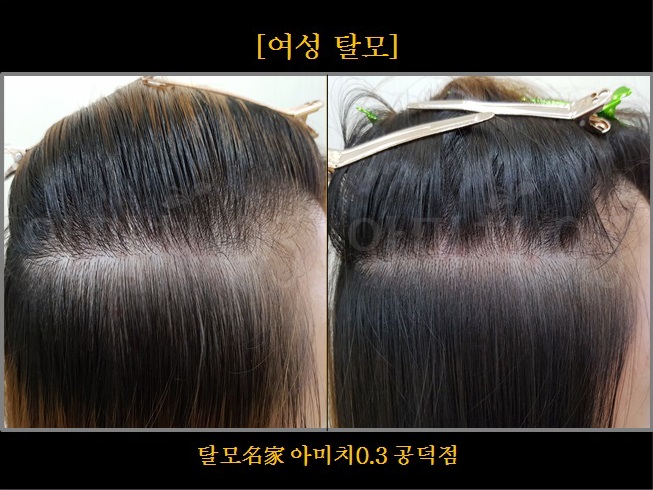 탈모 아미치 0.3 공덕점 대표 이미지