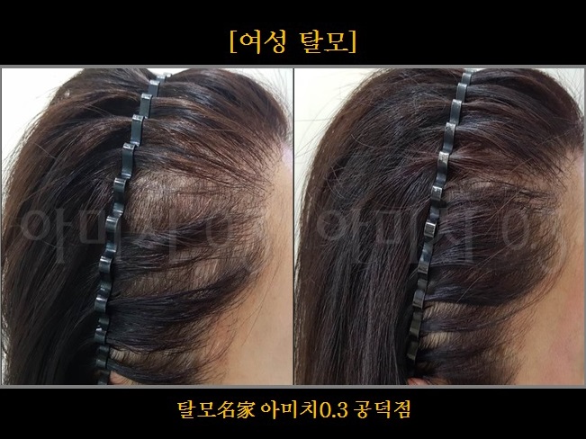 탈모 아미치 0.3 공덕점 대표 이미지