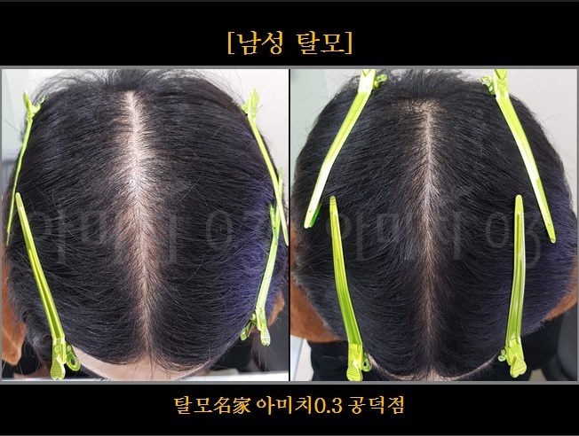 탈모 아미치 0.3 공덕점 대표 이미지