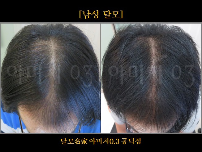 탈모 아미치 0.3 공덕점 대표 이미지