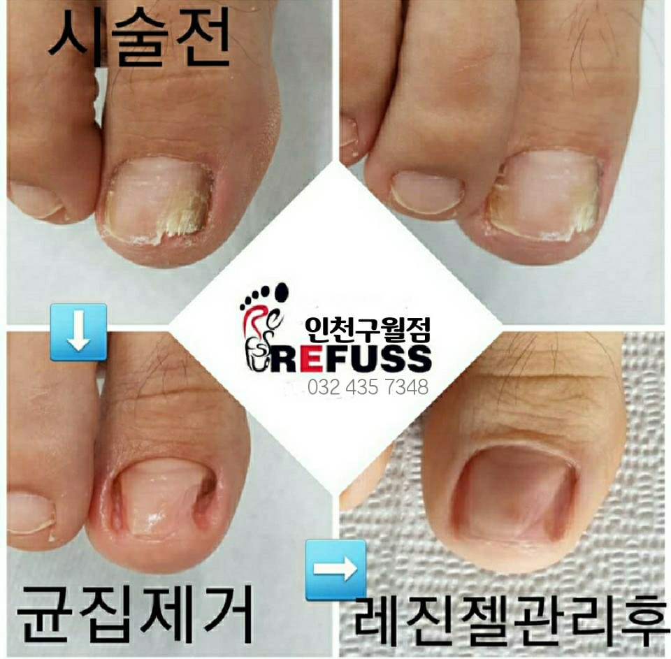 레푸스 구월점 내성발톱 무좀발톱 발각질 문제성발