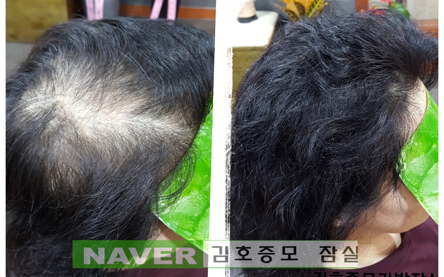 김호증모가발by리헤어