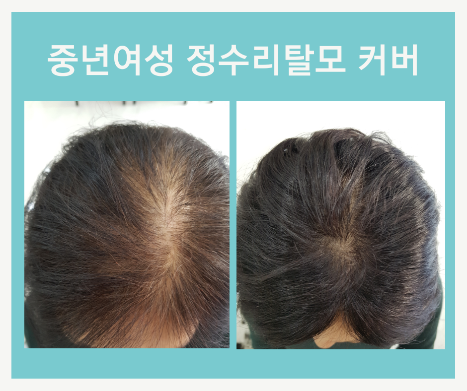 김호증모가발 끌리모헤어