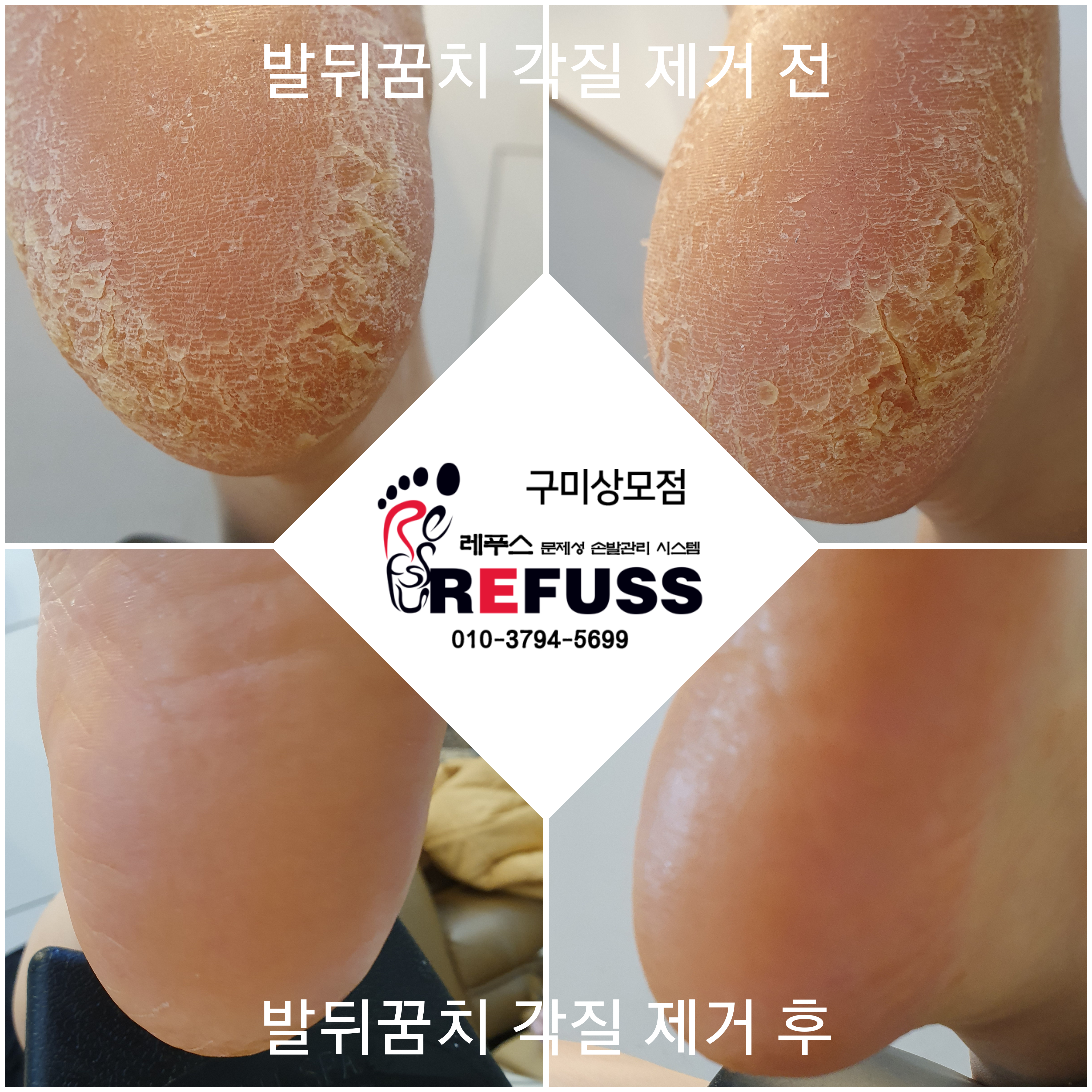 레푸스 구미시청점 내성발톱 발톱무좀 발각질