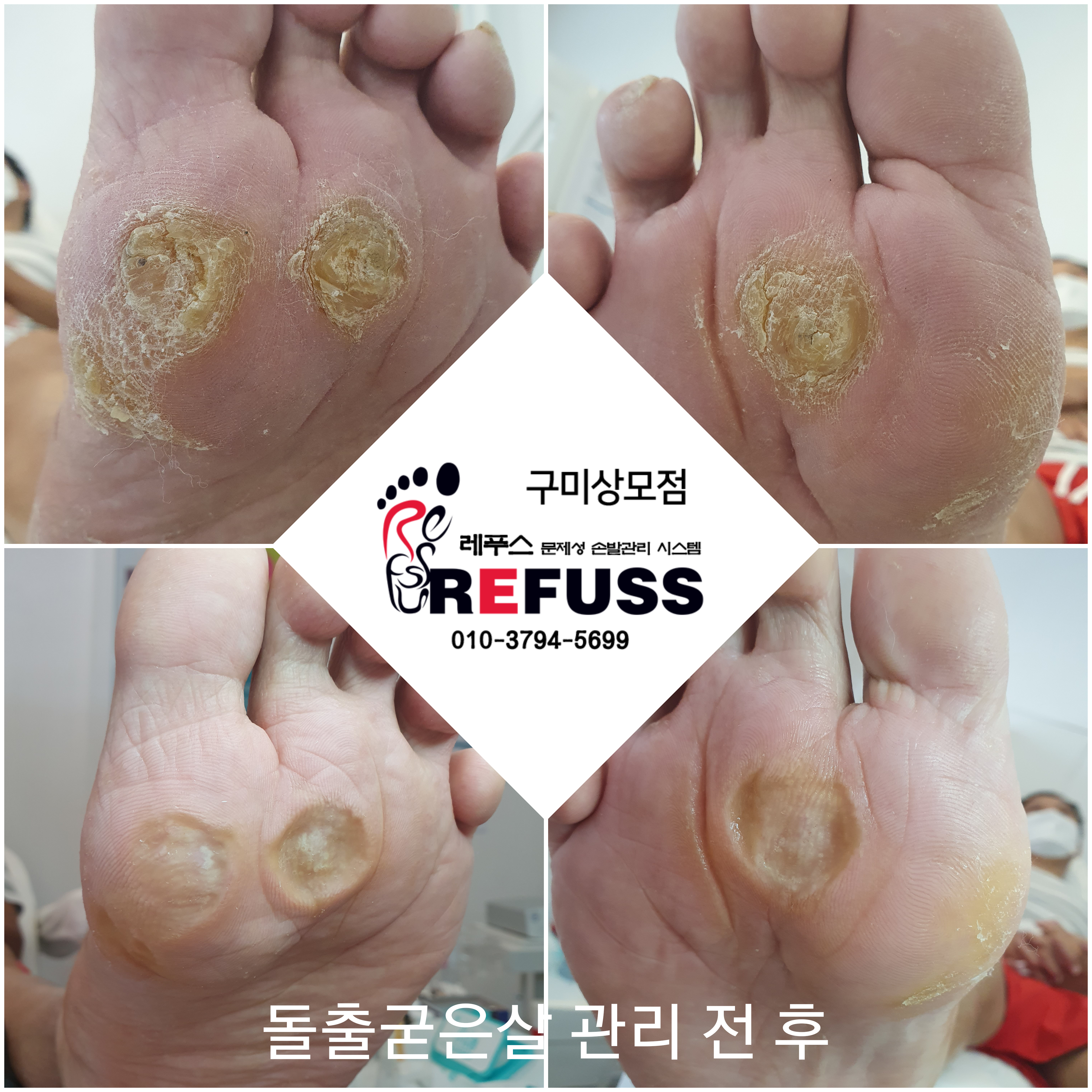 레푸스 구미시청점 내성발톱 발톱무좀 발각질
