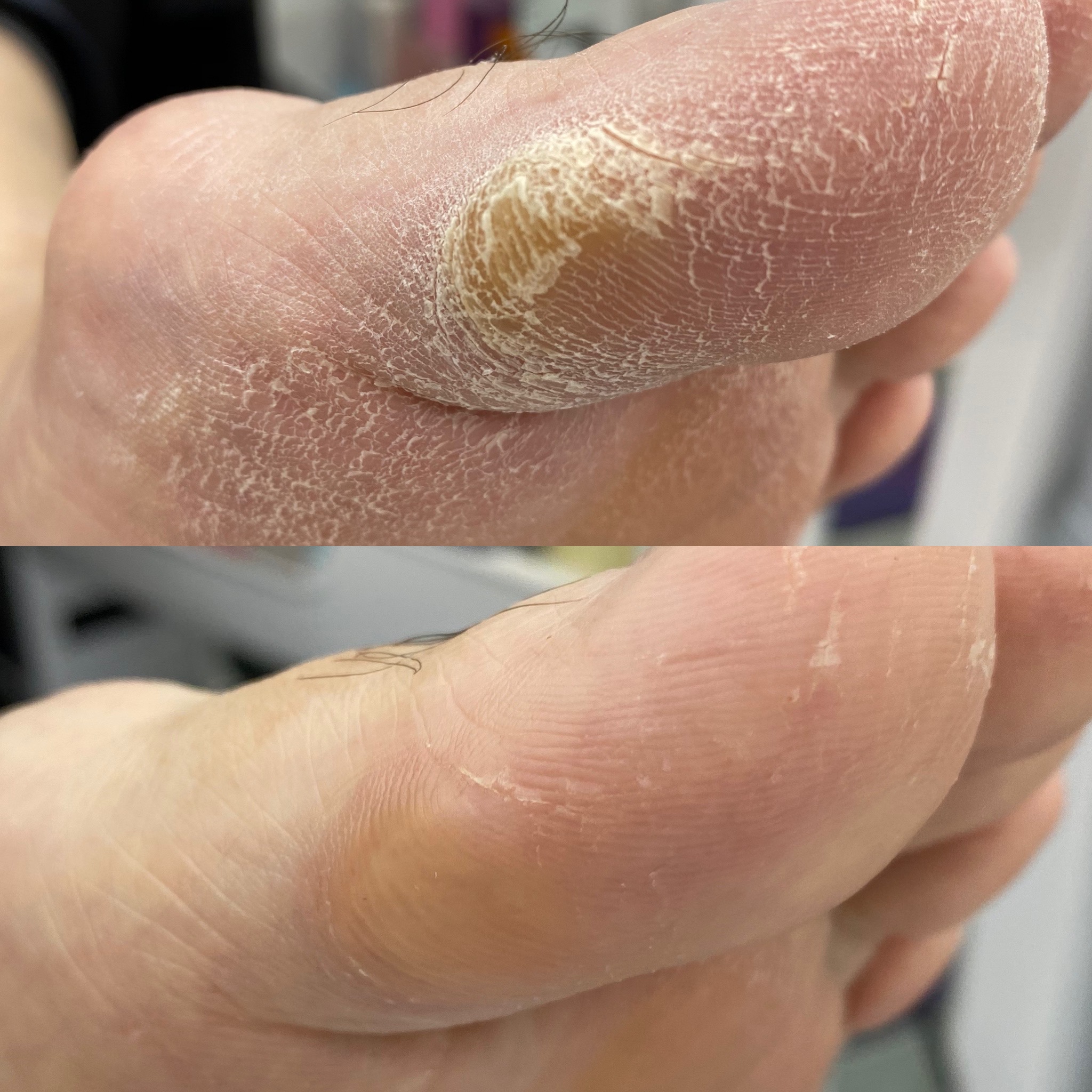 봉숭아손톱 레푸스 압구정점