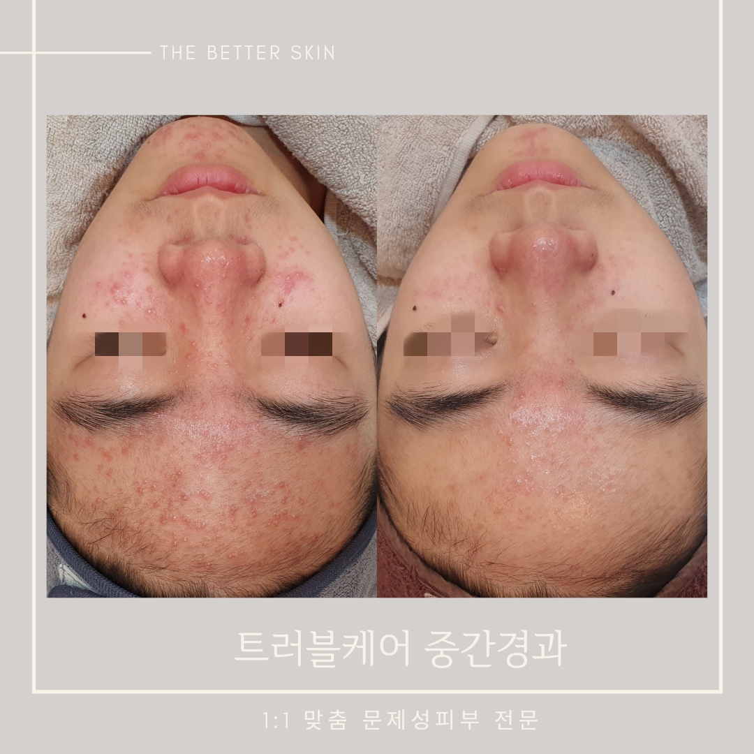 더좋은피부