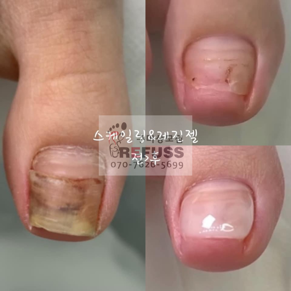 레푸스 구미시청점 내성발톱 발톱무좀 발각질