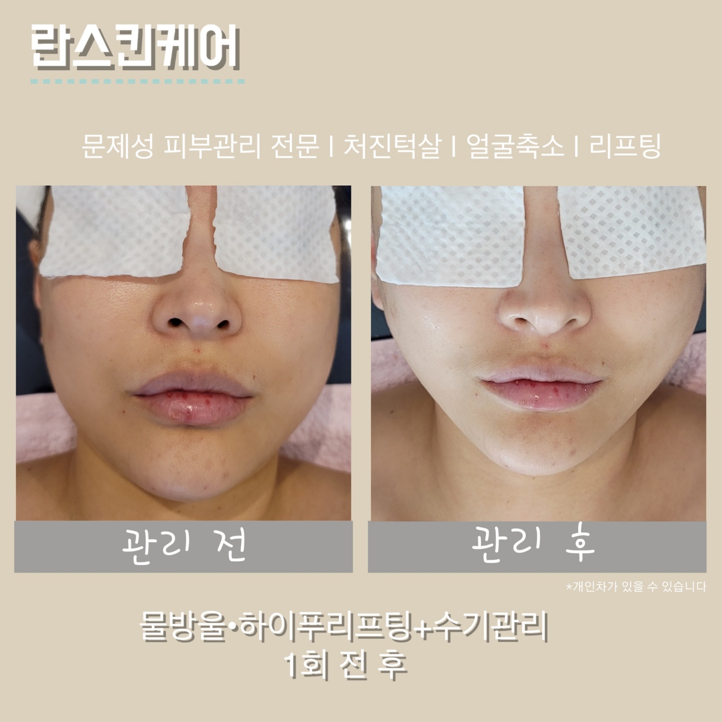 부천중동 란스킨케어