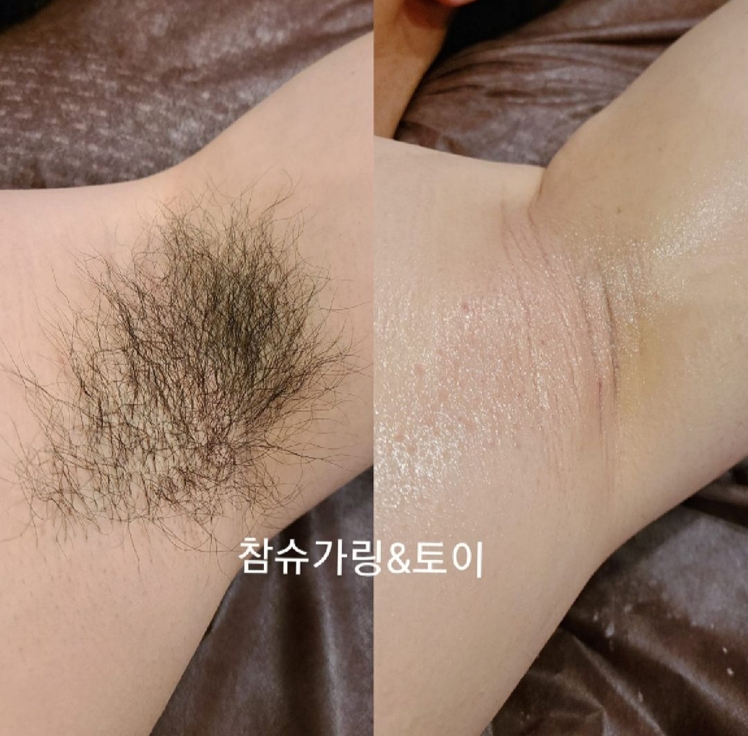 참슈가링왁싱