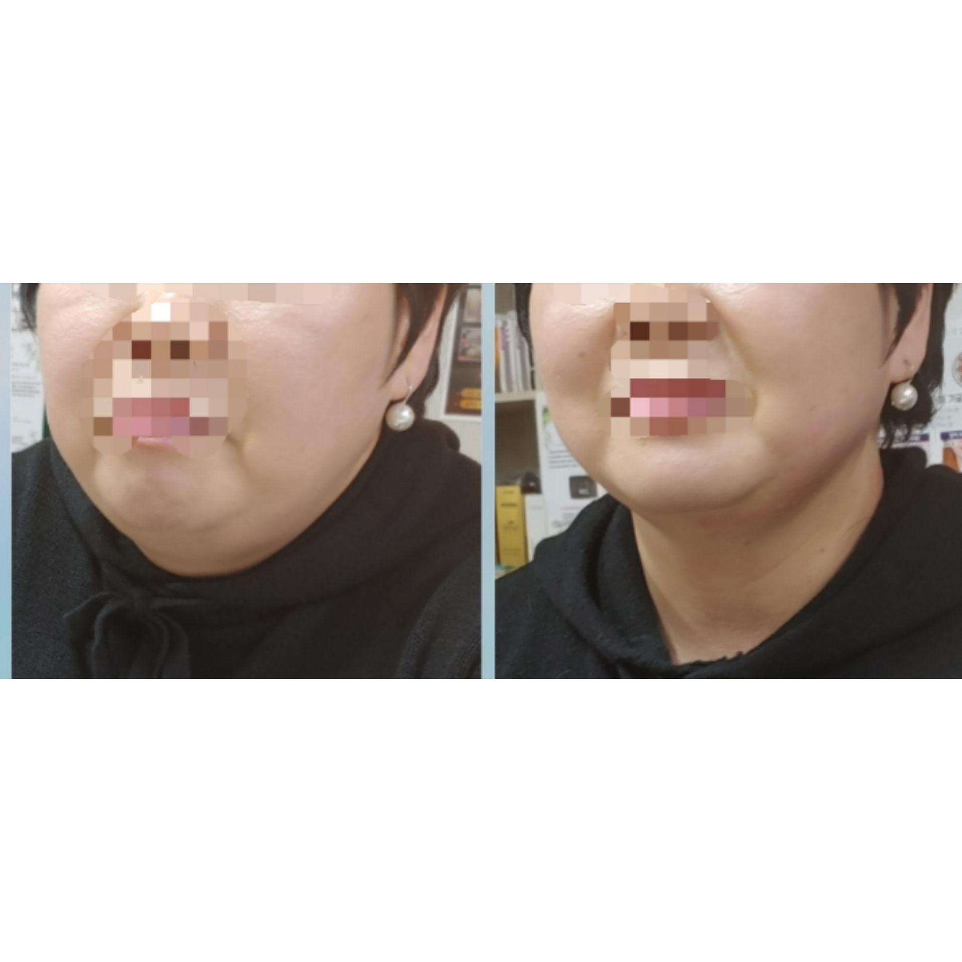 이아소에스떼