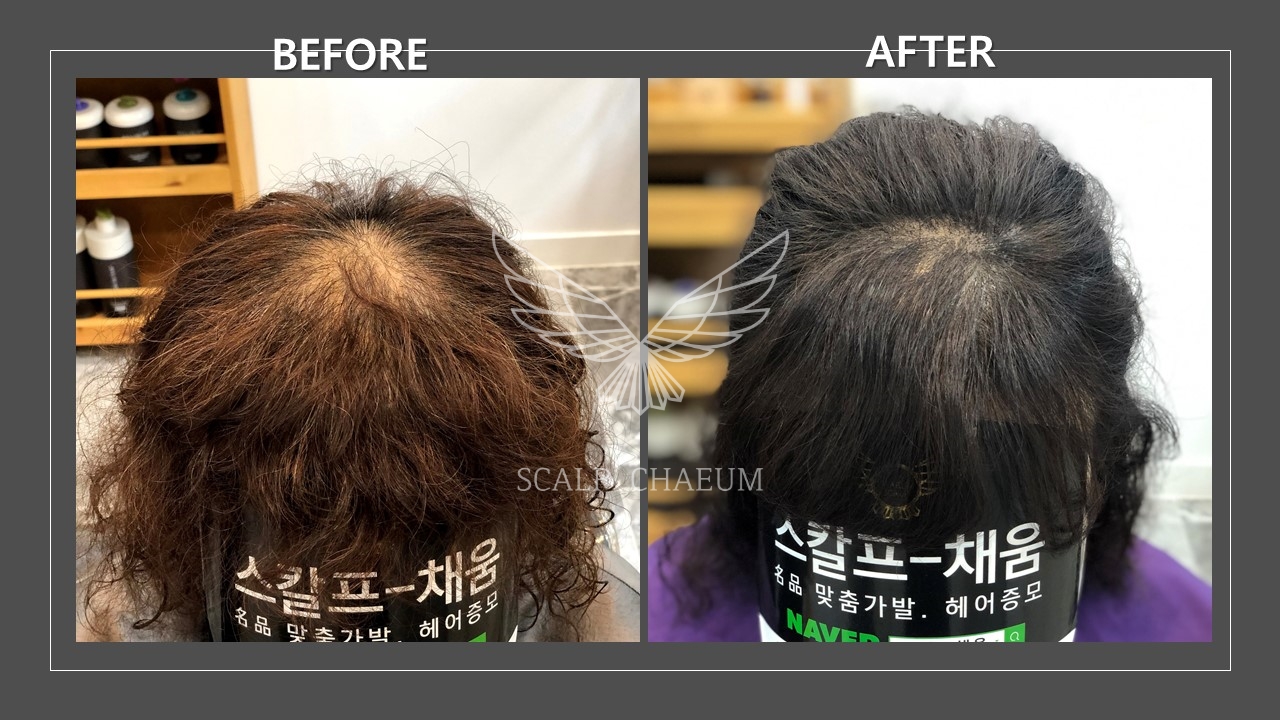 스칼프채움 대표 이미지
