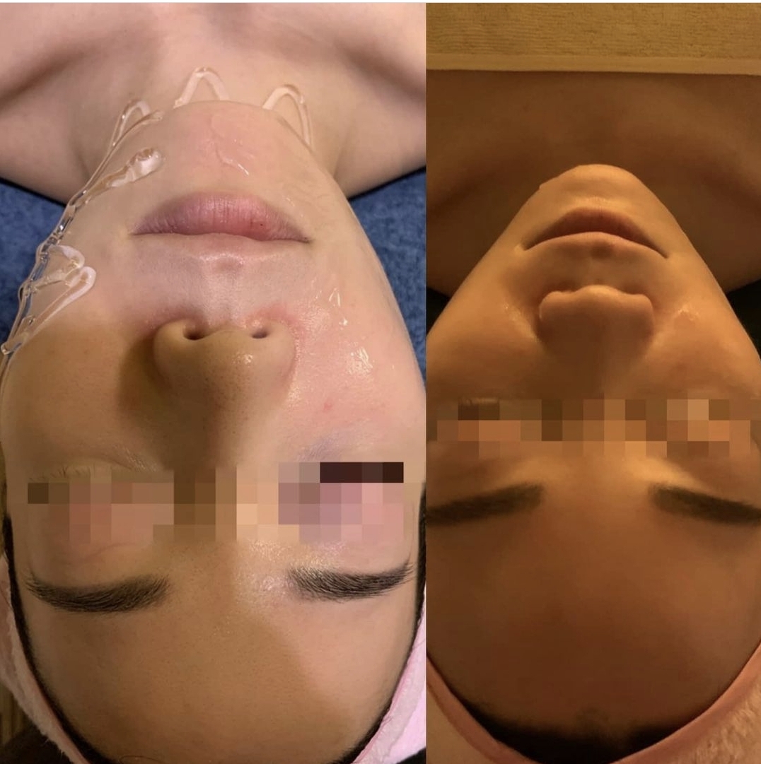 스와니예 좁쌀 여드름 관리 이미지