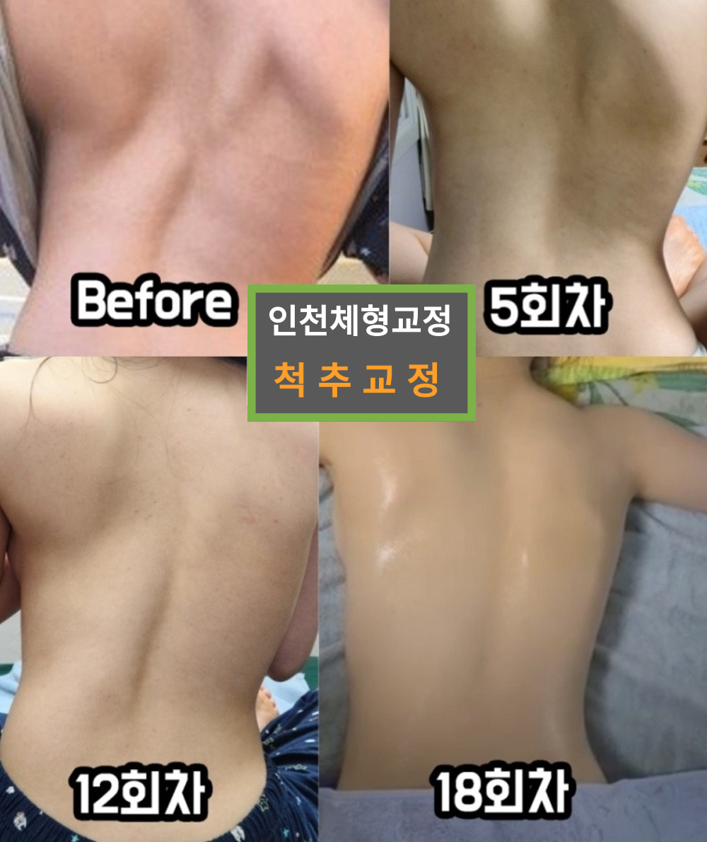 인천체형교정 photo 8