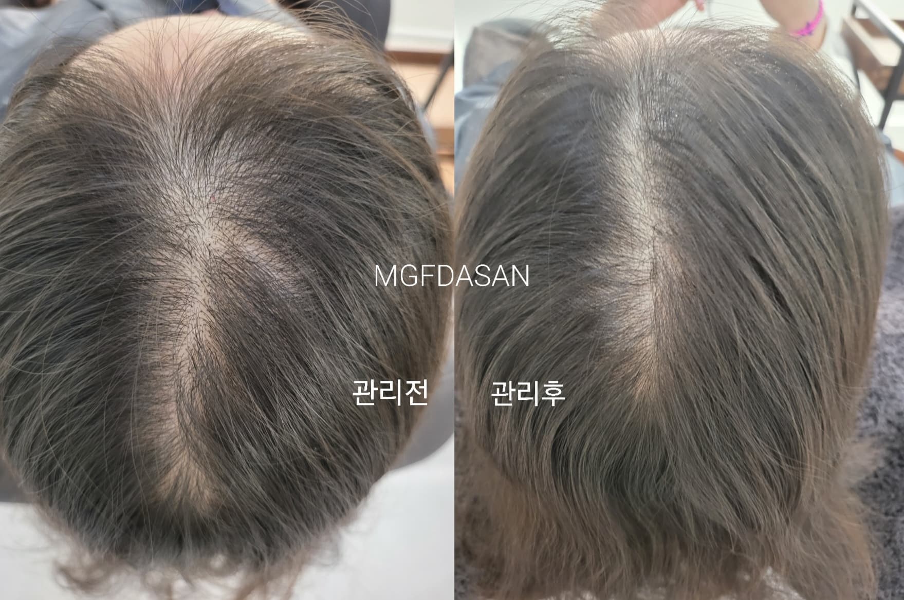엠지에프 두피탈모 전문센터 남양주다산점 대표 이미지