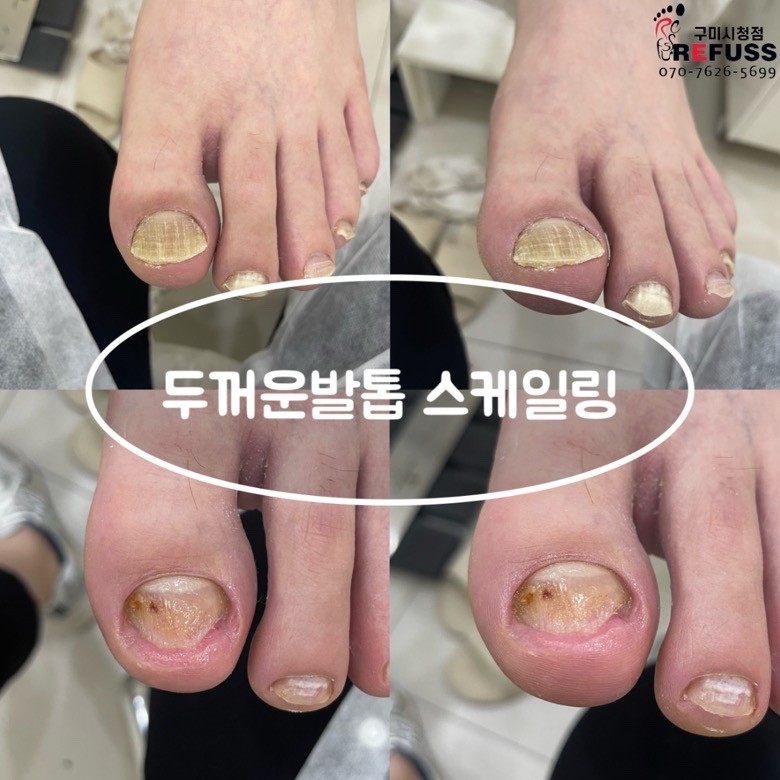 레푸스 구미시청점 내성발톱 발톱무좀 발각질
