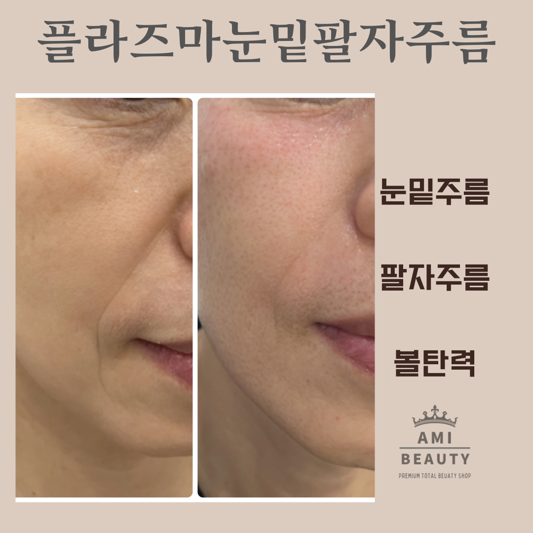 콜드플라즈마지사 아미뷰티 아카데미