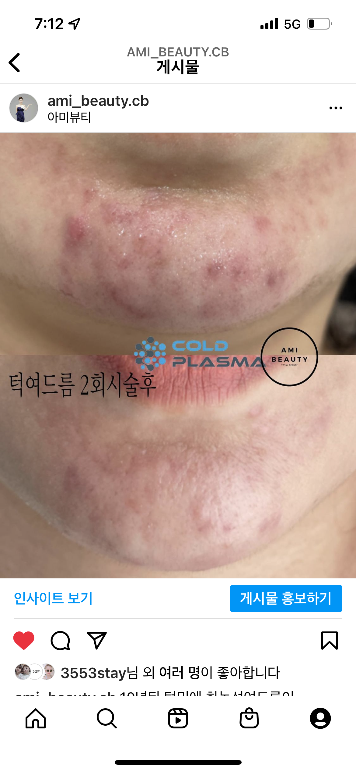 콜드플라즈마지사 아미뷰티 아카데미