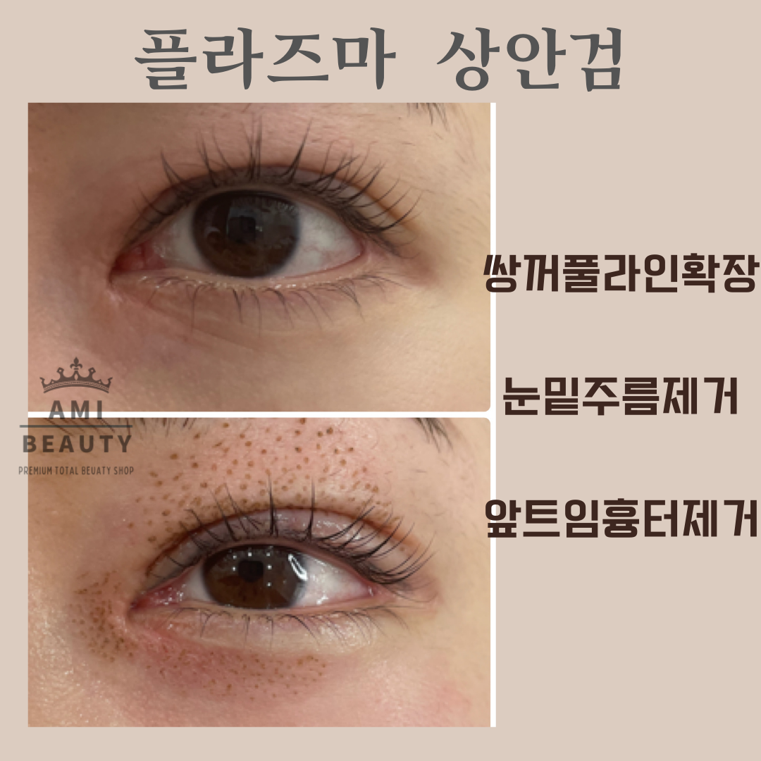 콜드플라즈마지사 아미뷰티 아카데미