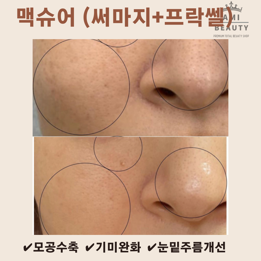 콜드플라즈마지사 아미뷰티 아카데미