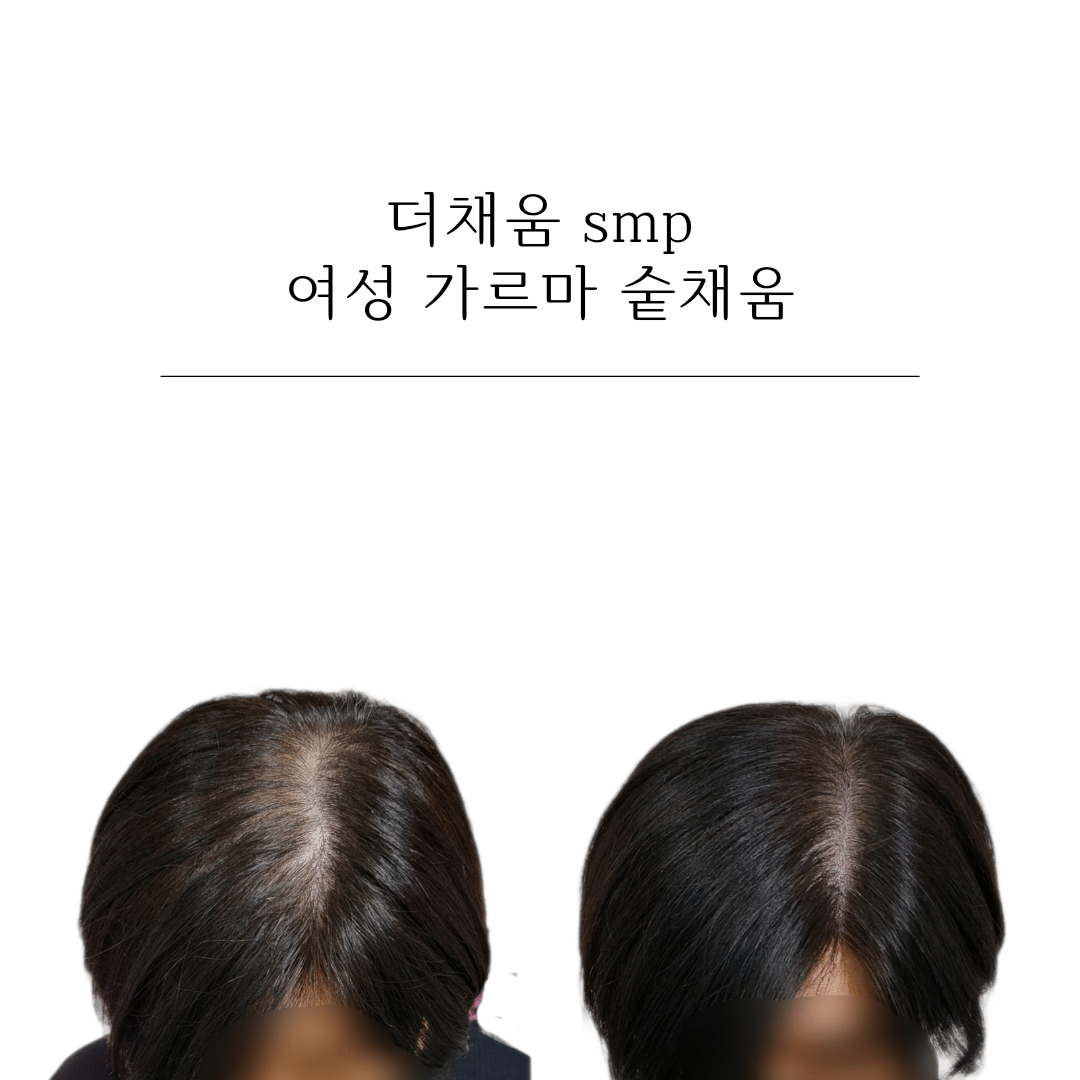 더채움 두피 SMP 대표 이미지