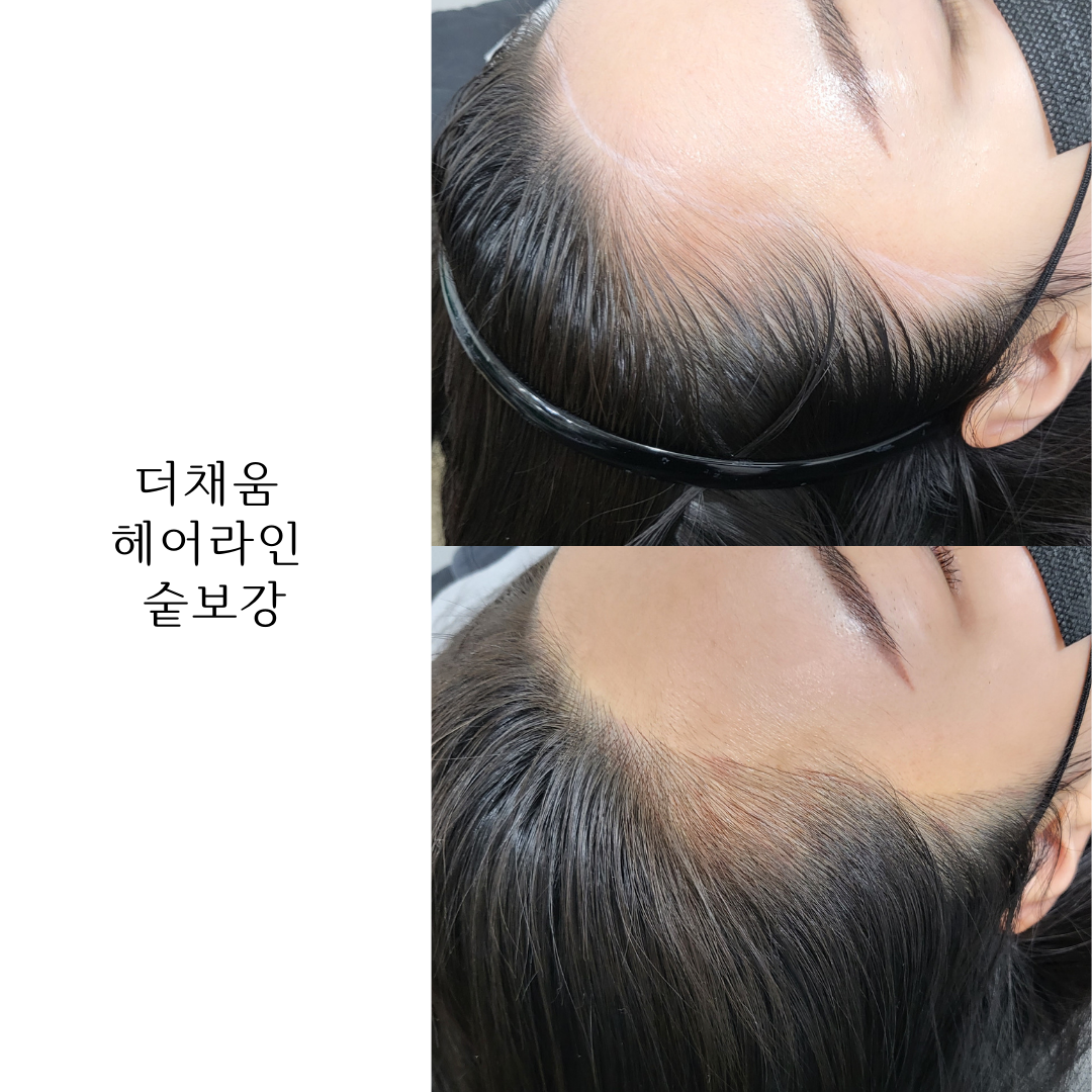 더채움 두피 SMP 대표 이미지
