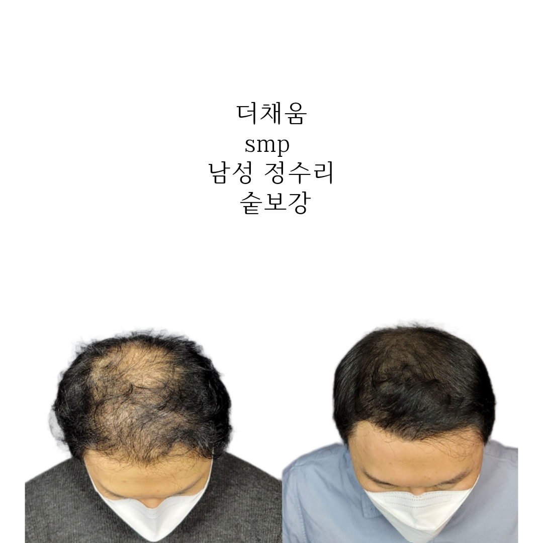 더채움 두피 SMP 대표 이미지