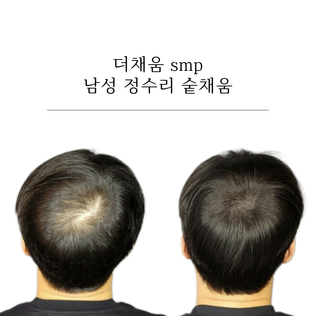 더채움 두피 SMP 대표 이미지