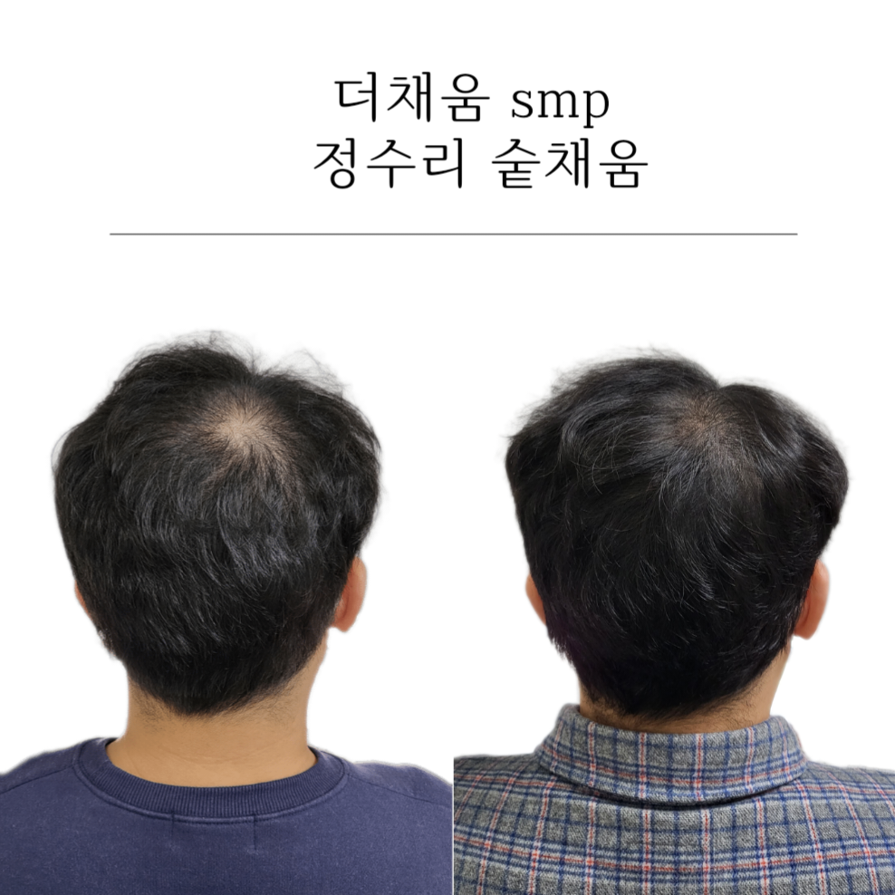 더채움 두피 SMP 대표 이미지