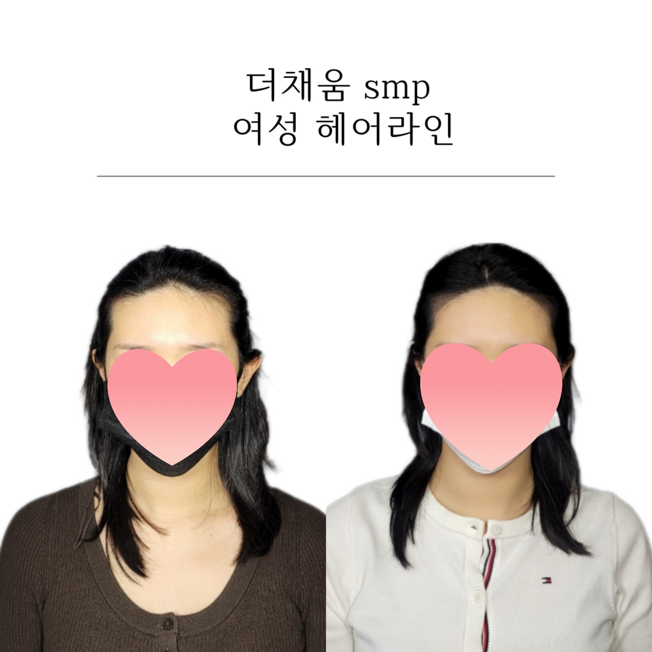 더채움 두피 SMP 시술 이미지