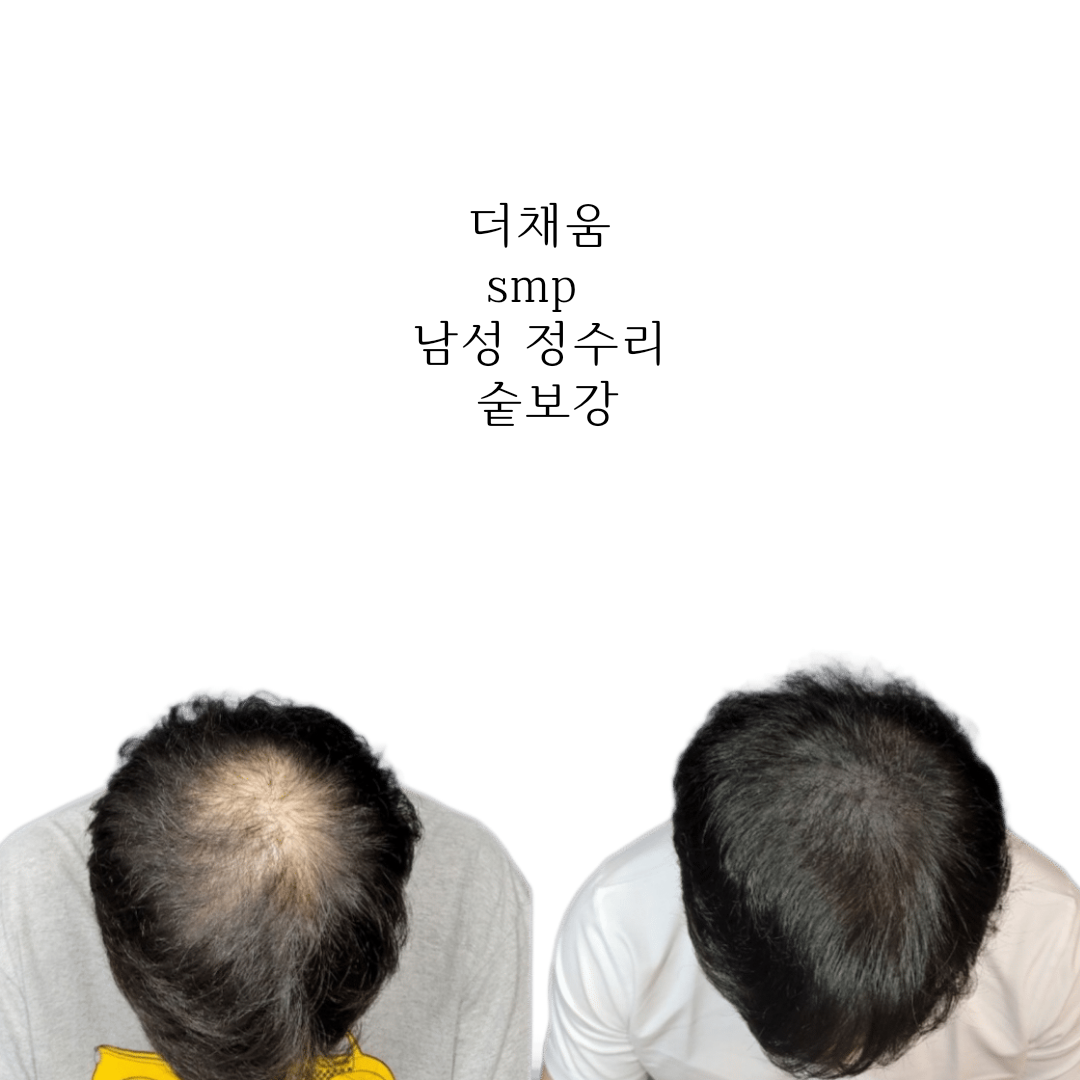 더채움 두피 SMP 대표 이미지