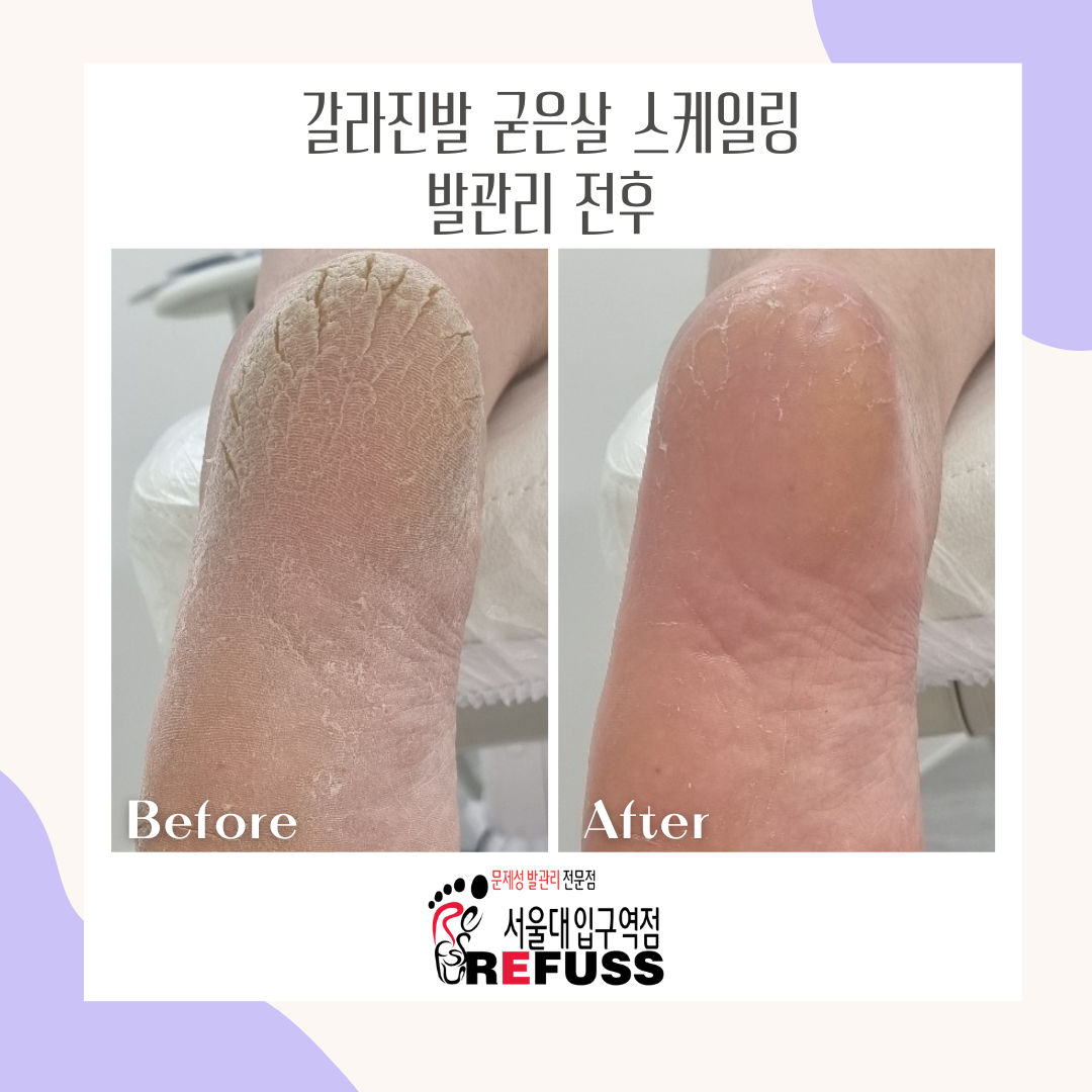 레푸스 발각질 내성발톱 무좀발톱 관리 대표 이미지