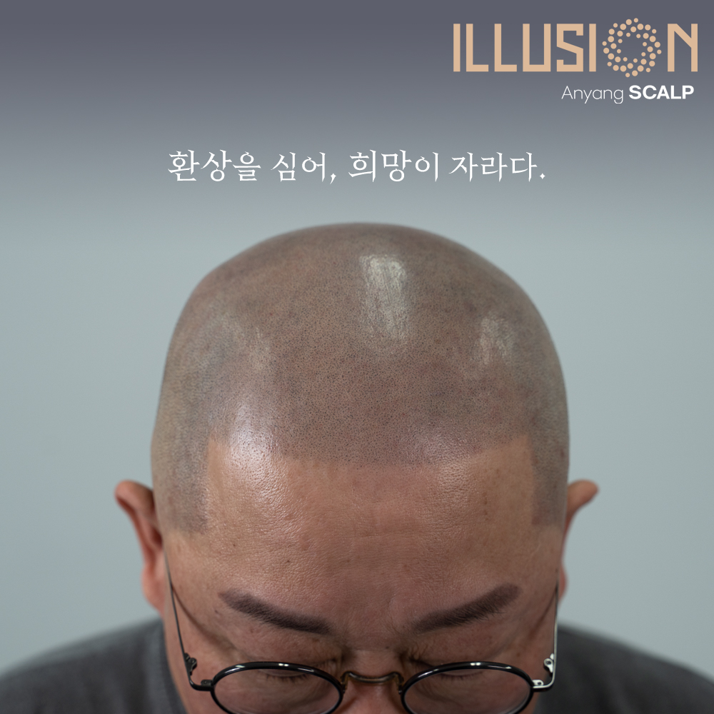 일루젼스칼프 안양