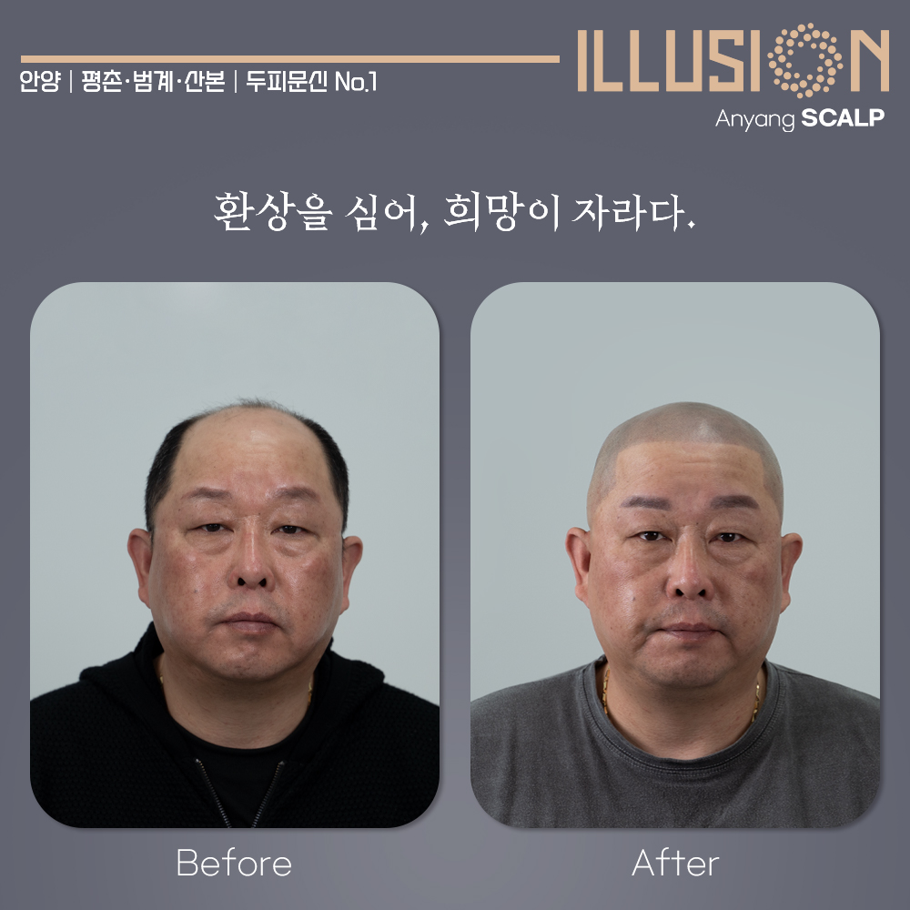일루젼스칼프 안양