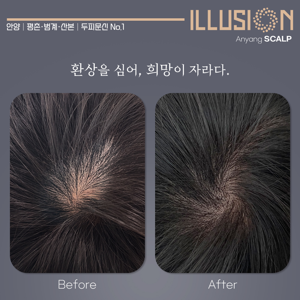 일루젼스칼프 안양