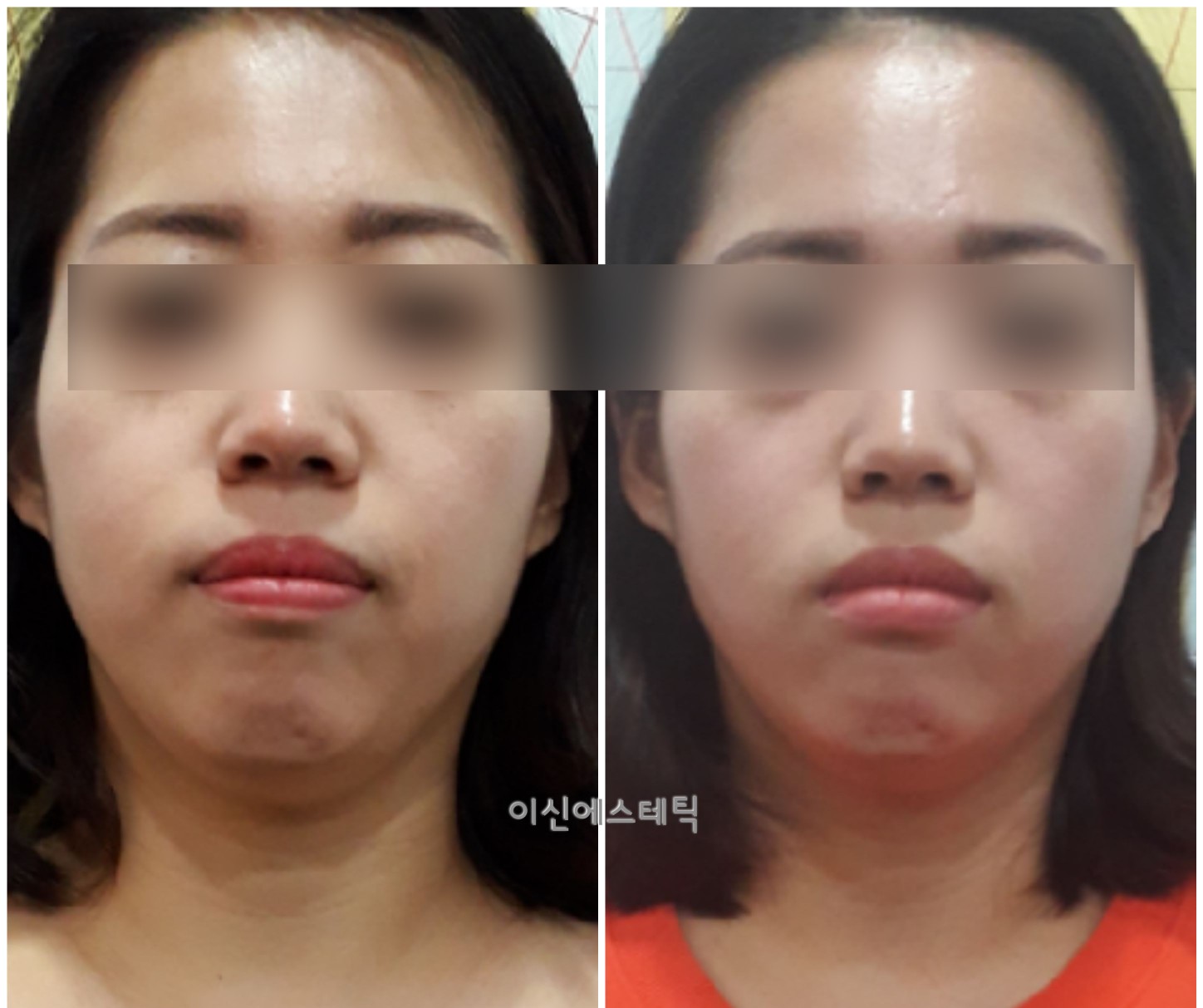 이신에스테틱 부산하단점