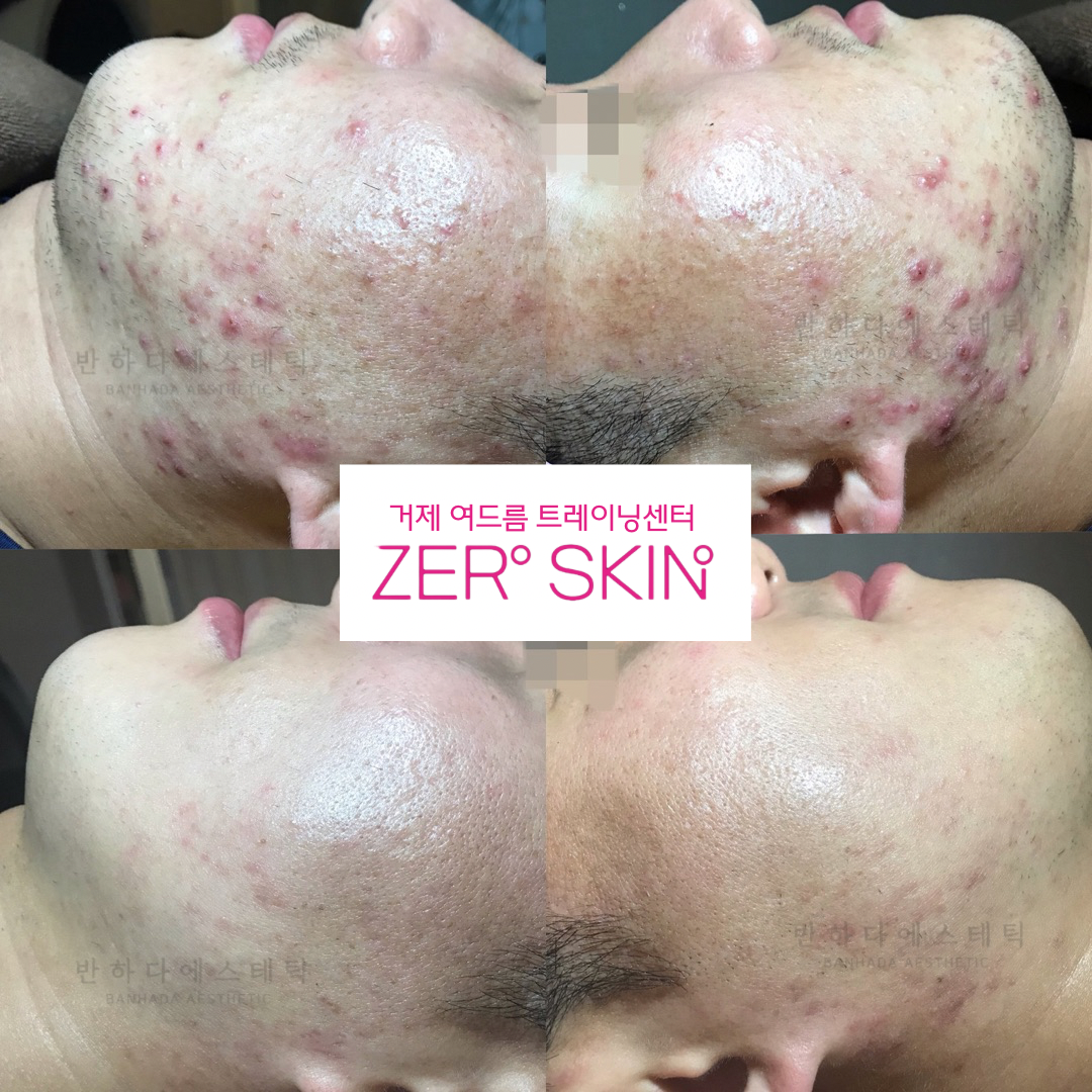 제로스킨 홍대 대표 이미지