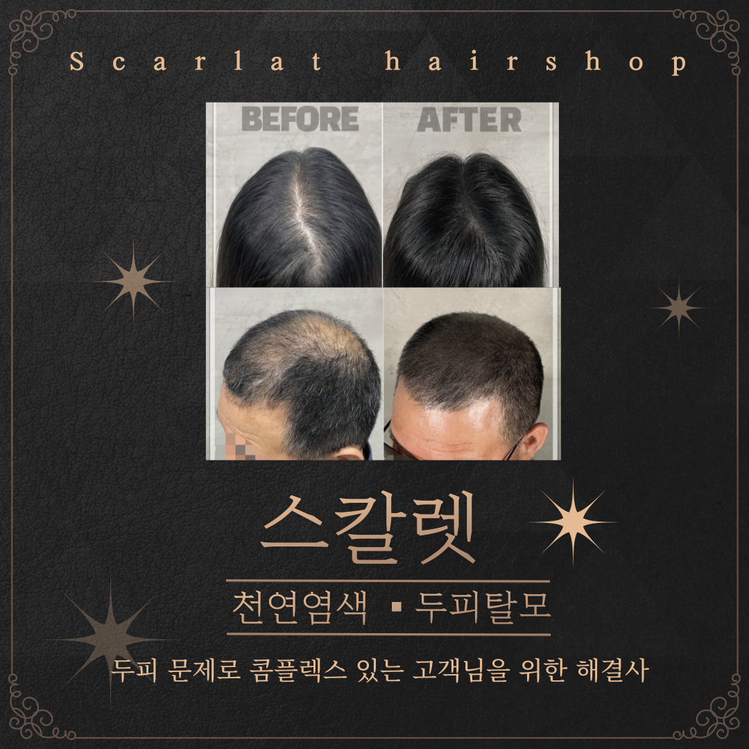 더스칼렛두피탈모센터