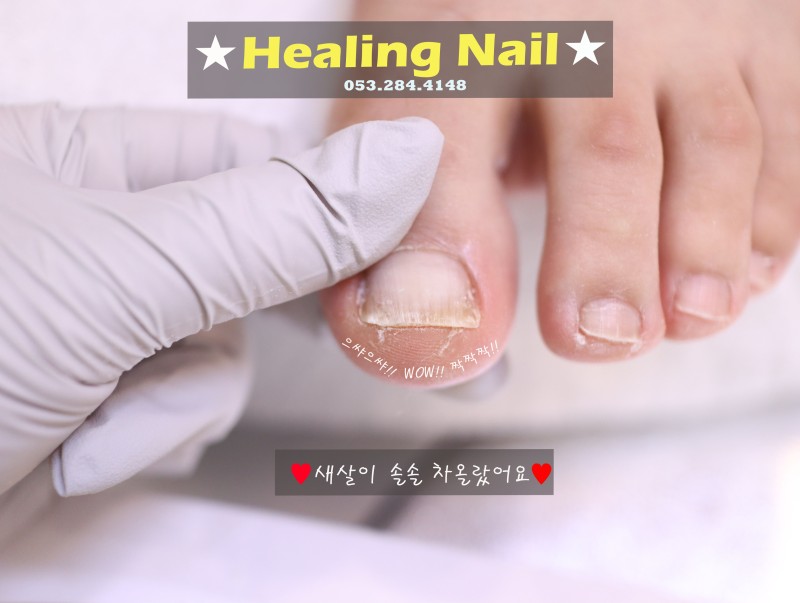 힐링네일&힐링푸스 내성발톱 발톱무좀 손톱교정 발각질티눈 대표 이미지