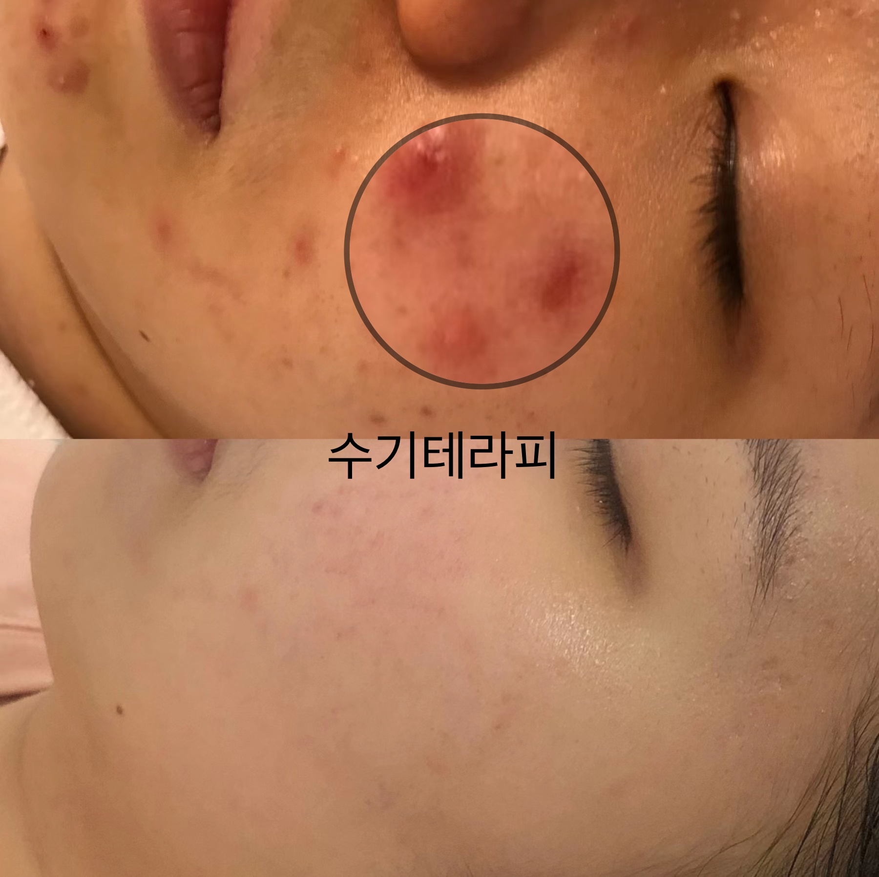 초선 수기테라피 photo 6