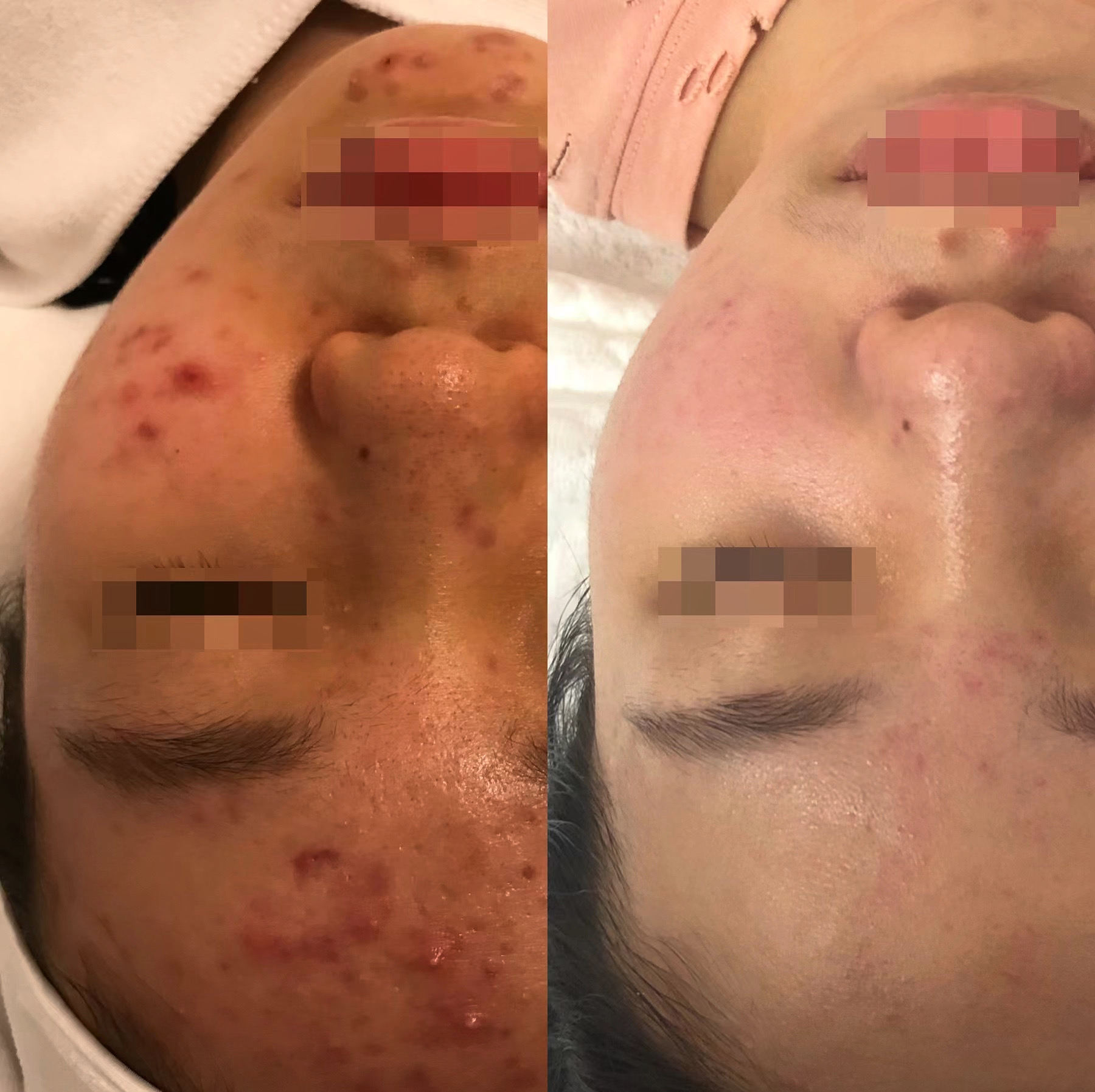 초선 수기테라피 photo 2