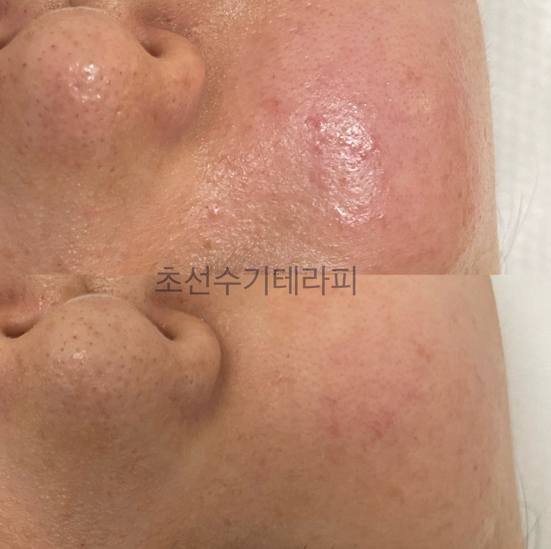 초선 수기테라피 photo 4