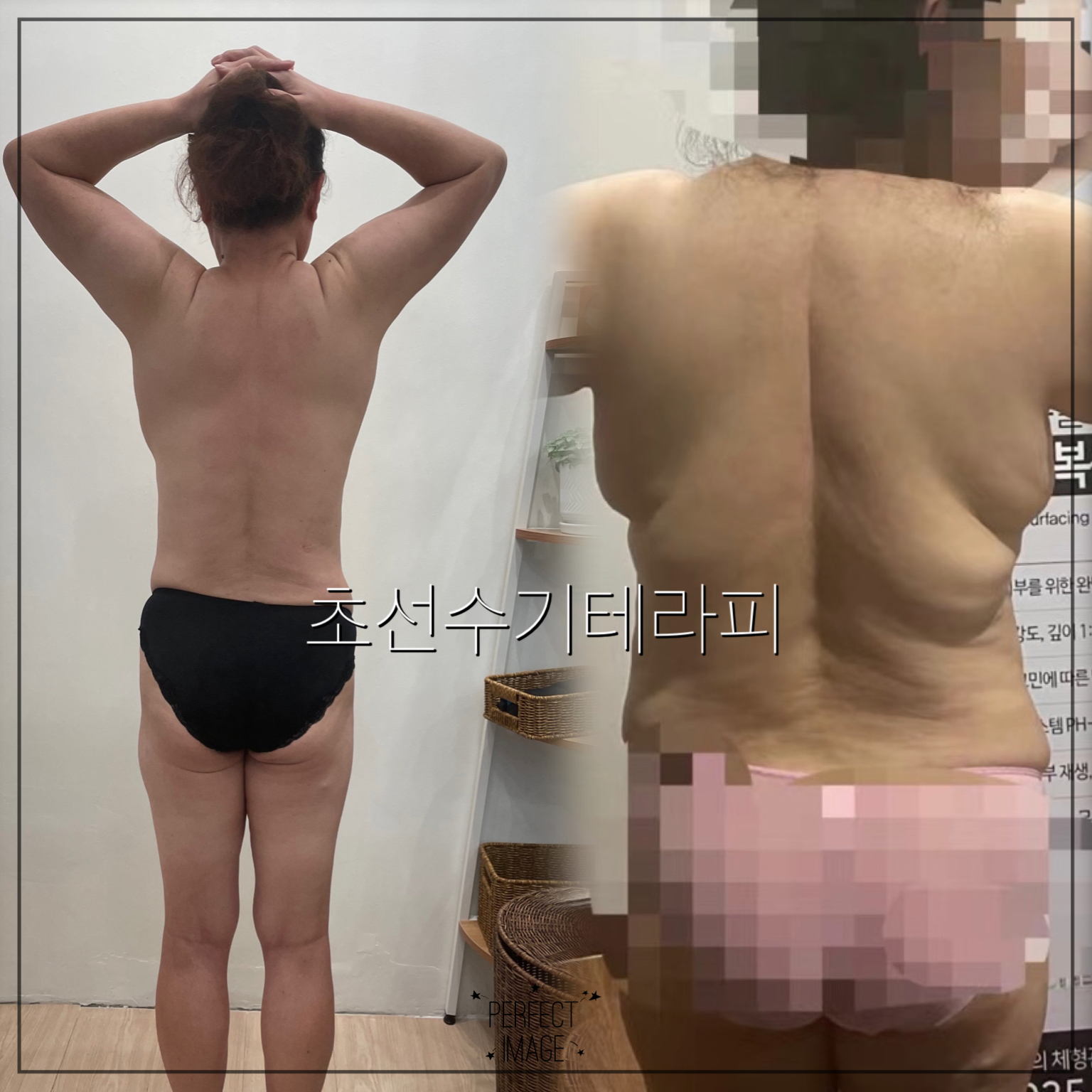초선 수기테라피 photo 3